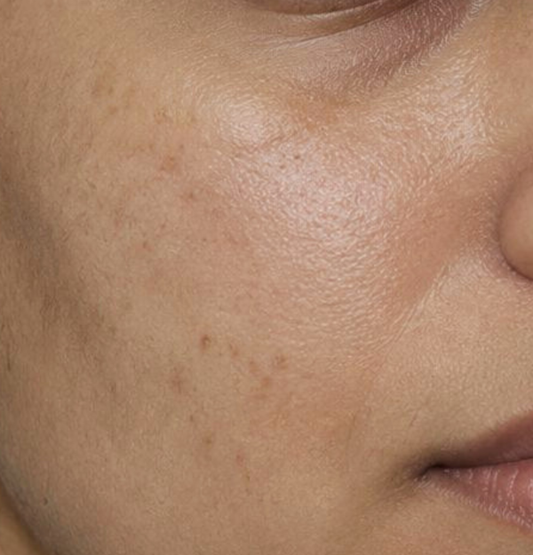 Dull Skin