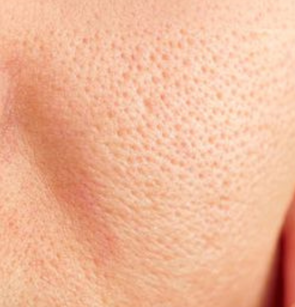 Open Pores
